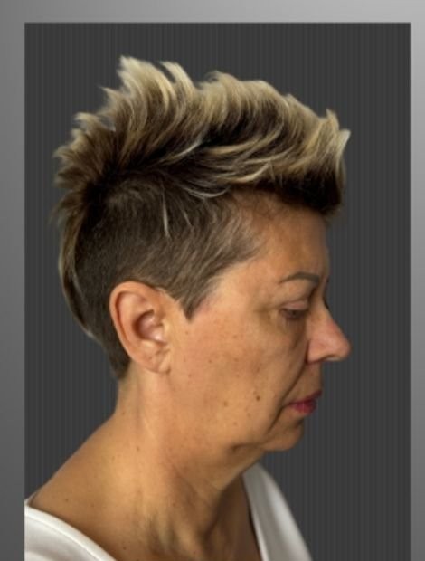 Umut Zereyak facelift case 5, before photograph from the credited source gallery