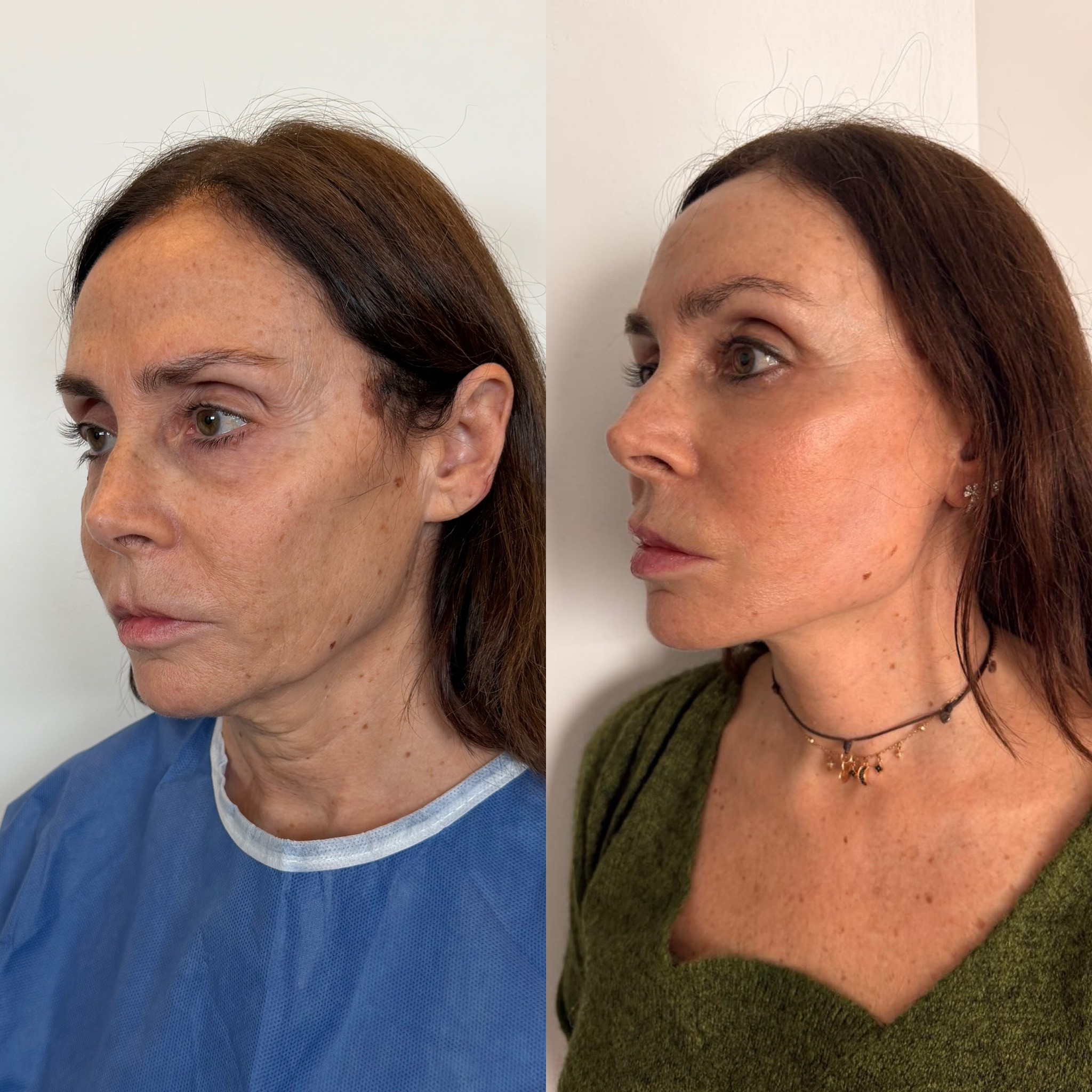 Before-and-after neck or face-and-neck lift comparison, Dr. Cem Berkay Sinaci source gallery, view 1