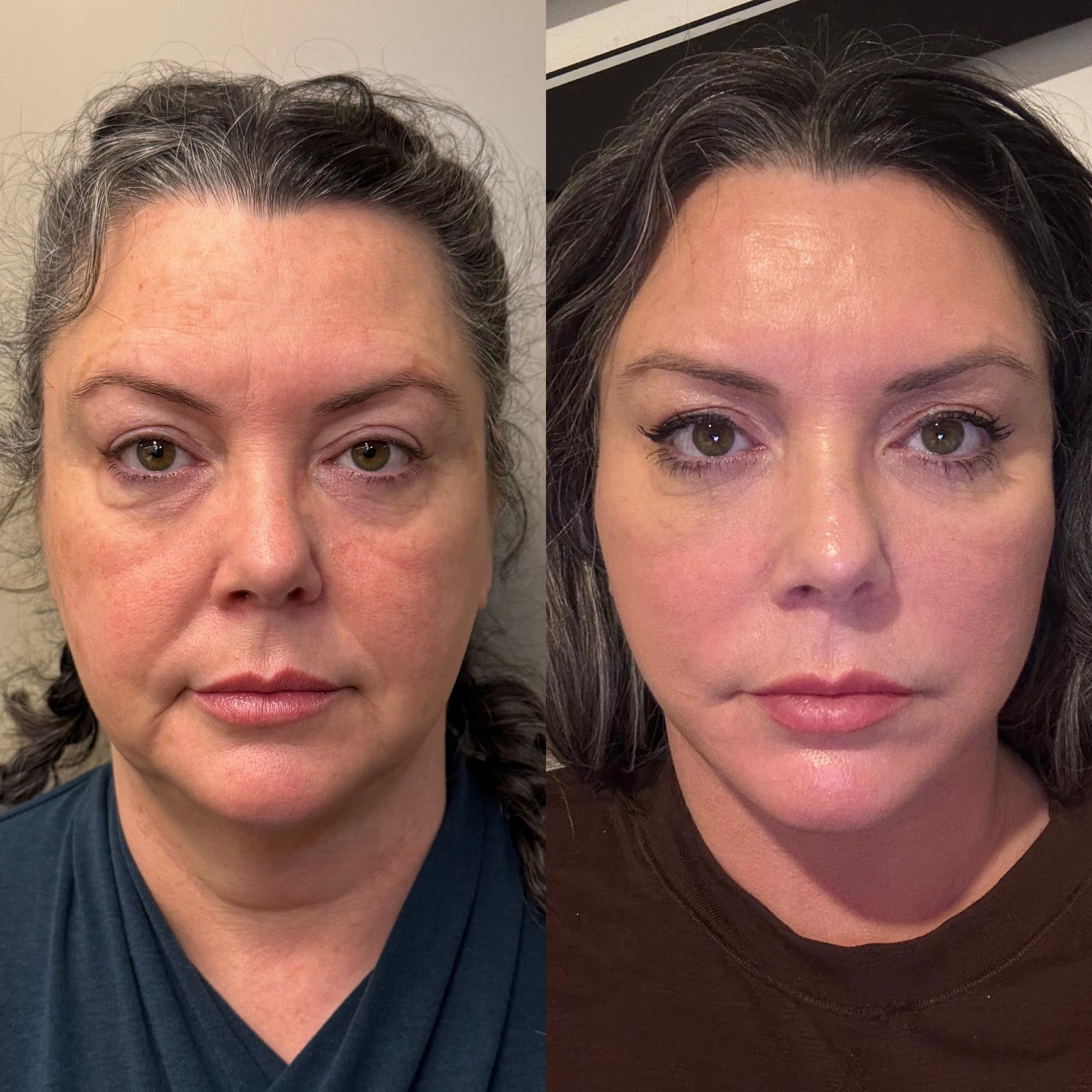 Before-and-after neck or face-and-neck lift comparison, Dr. Cem Berkay Sinaci source gallery, view 2