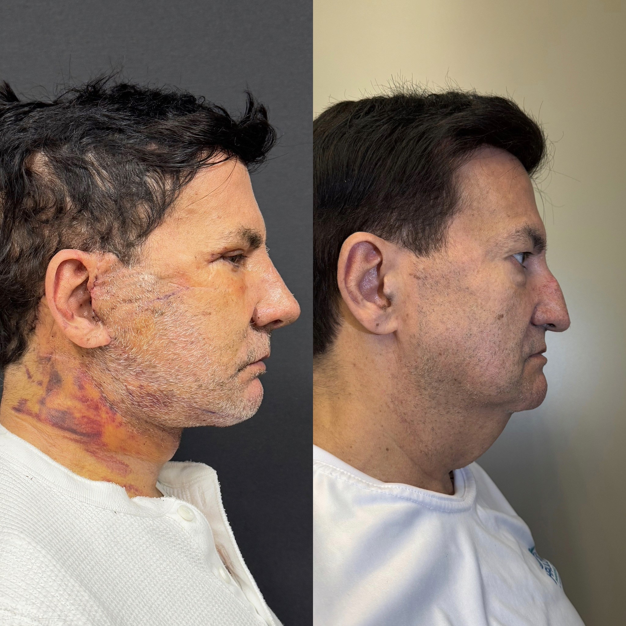 Before-and-after neck or face-and-neck lift comparison, Dr. Cem Berkay Sinaci source gallery, view 4