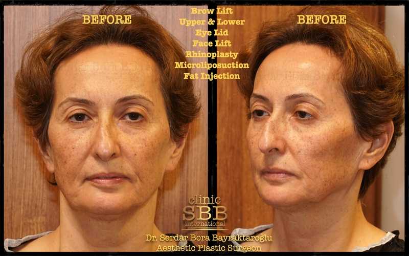 Before-and-after neck or face-and-neck lift comparison, Clinic SBB source gallery, view 1