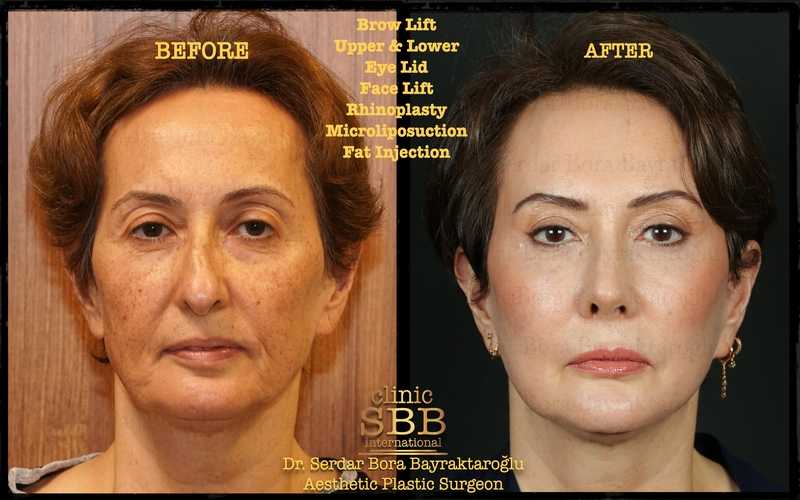 Before-and-after neck or face-and-neck lift comparison, Clinic SBB source gallery, view 2