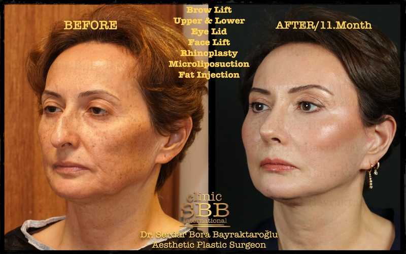 Before-and-after neck or face-and-neck lift comparison, Clinic SBB source gallery, view 3