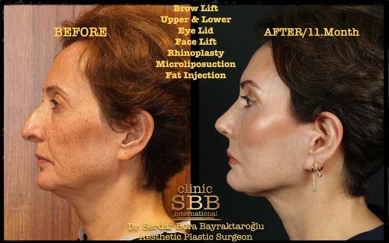 Before-and-after neck or face-and-neck lift comparison, Clinic SBB source gallery, view 4
