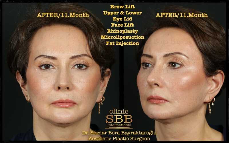 Before-and-after neck or face-and-neck lift comparison, Clinic SBB source gallery, view 5