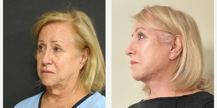 Before-and-after neck or face-and-neck lift comparison, Dr. Ercan Karacaoglu source gallery, view 1
