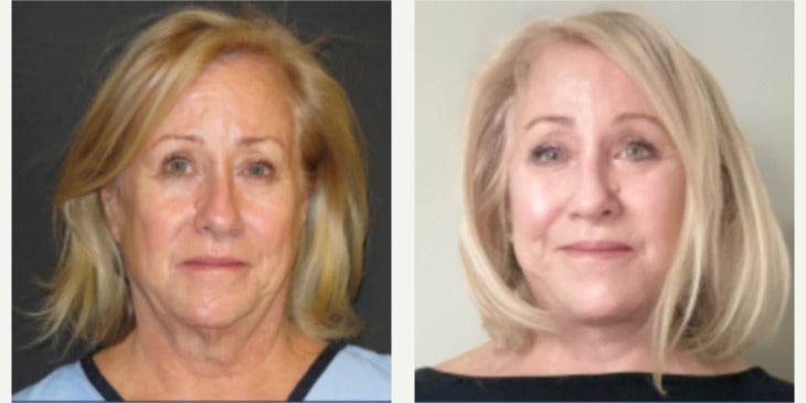 Before-and-after neck or face-and-neck lift comparison, Dr. Ercan Karacaoglu source gallery, view 2
