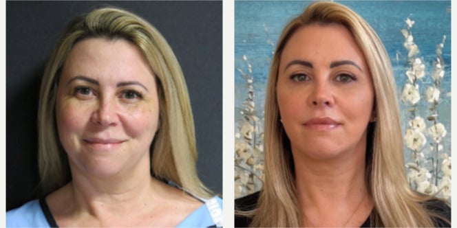 Before-and-after neck or face-and-neck lift comparison, Dr. Ercan Karacaoglu source gallery, view 3