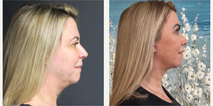 Before-and-after neck or face-and-neck lift comparison, Dr. Ercan Karacaoglu source gallery, view 4