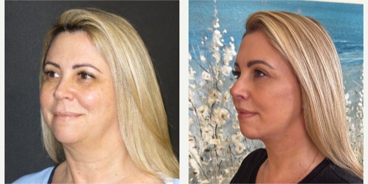 Before-and-after neck or face-and-neck lift comparison, Dr. Ercan Karacaoglu source gallery, view 5