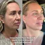 Before-and-after neck or face-and-neck lift comparison, Dr. Erman Ak source gallery, view 1