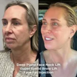 Before-and-after neck or face-and-neck lift comparison, Dr. Erman Ak source gallery, view 2