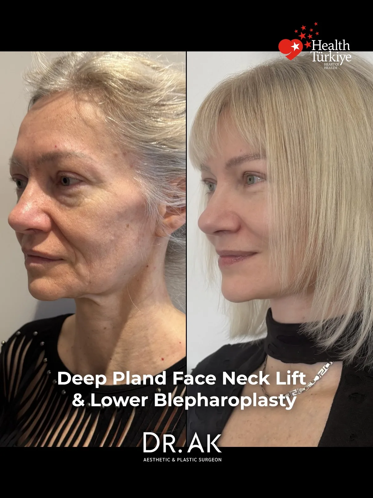 Before-and-after neck or face-and-neck lift comparison, Dr. Erman Ak source gallery, view 3