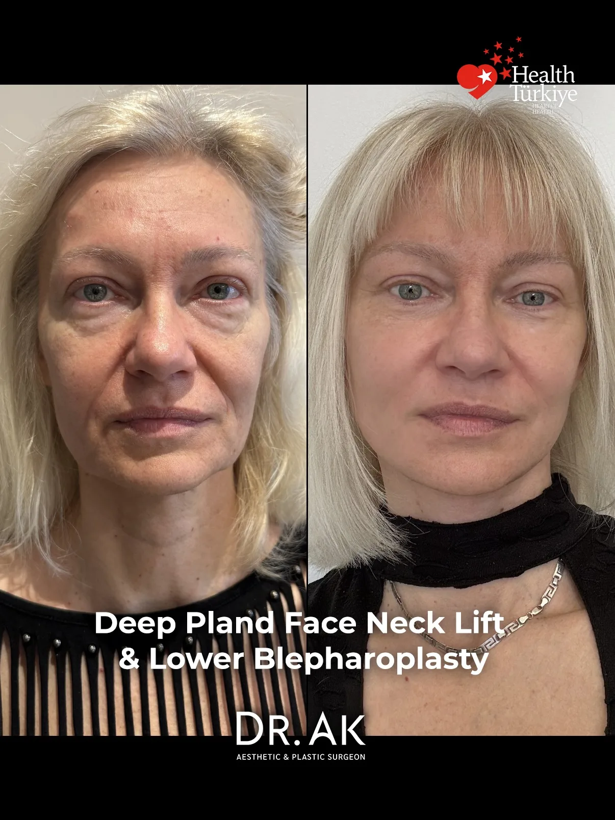 Before-and-after neck or face-and-neck lift comparison, Dr. Erman Ak source gallery, view 4