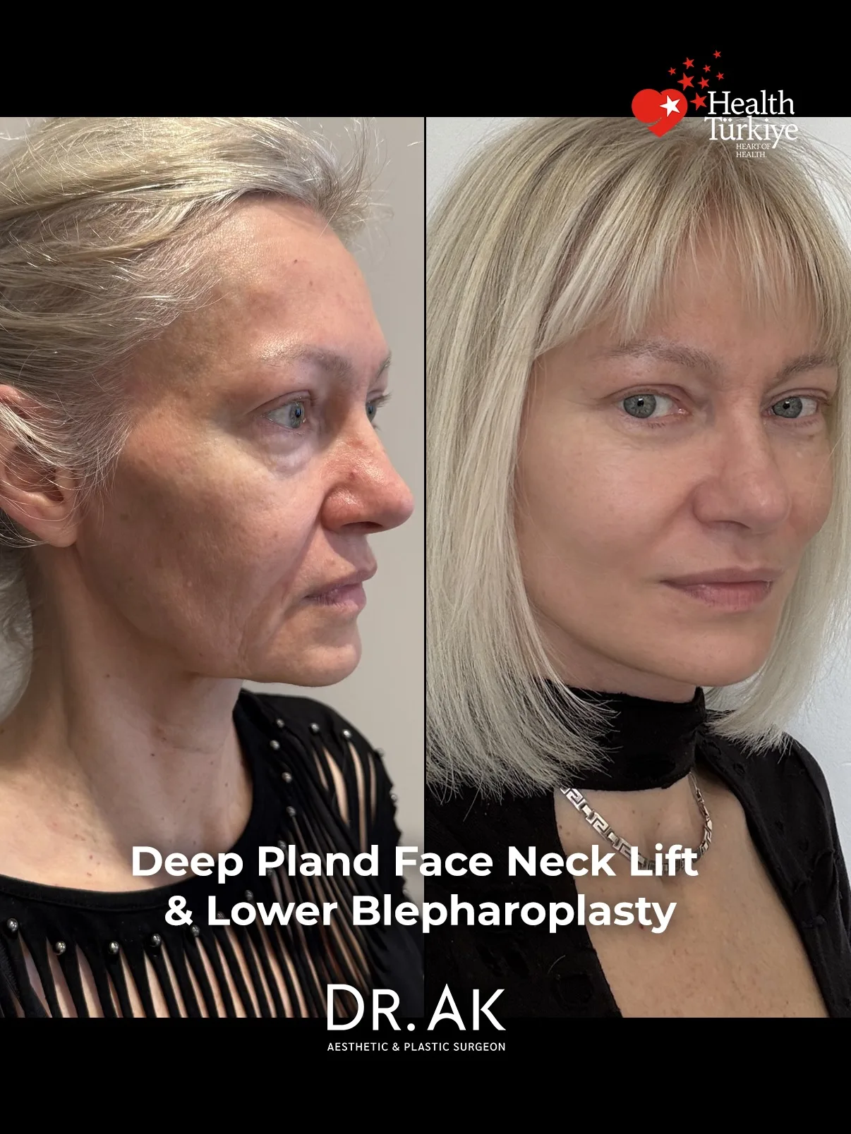 Before-and-after neck or face-and-neck lift comparison, Dr. Erman Ak source gallery, view 5