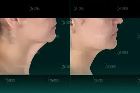 Before-and-after neck or face-and-neck lift comparison, Estetik International source gallery, view 1