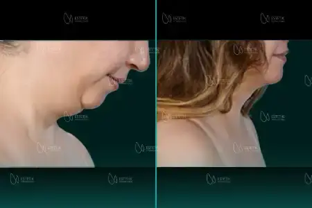 Before-and-after neck or face-and-neck lift comparison, Estetik International source gallery, view 2