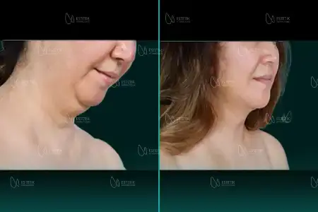 Before-and-after neck or face-and-neck lift comparison, Estetik International source gallery, view 3