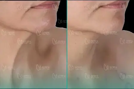 Before-and-after neck or face-and-neck lift comparison, Estetik International source gallery, view 4