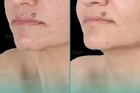 Before-and-after neck or face-and-neck lift comparison, Estetik International source gallery, view 5