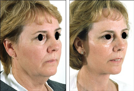 Before-and-after neck or face-and-neck lift comparison, Dr. Hakan Demir source gallery, view 1