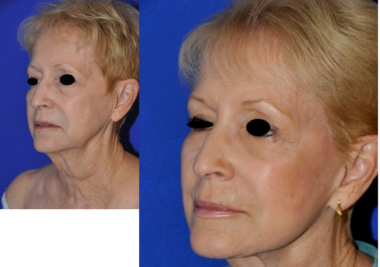 Before-and-after neck or face-and-neck lift comparison, Dr. Hakan Demir source gallery, view 2