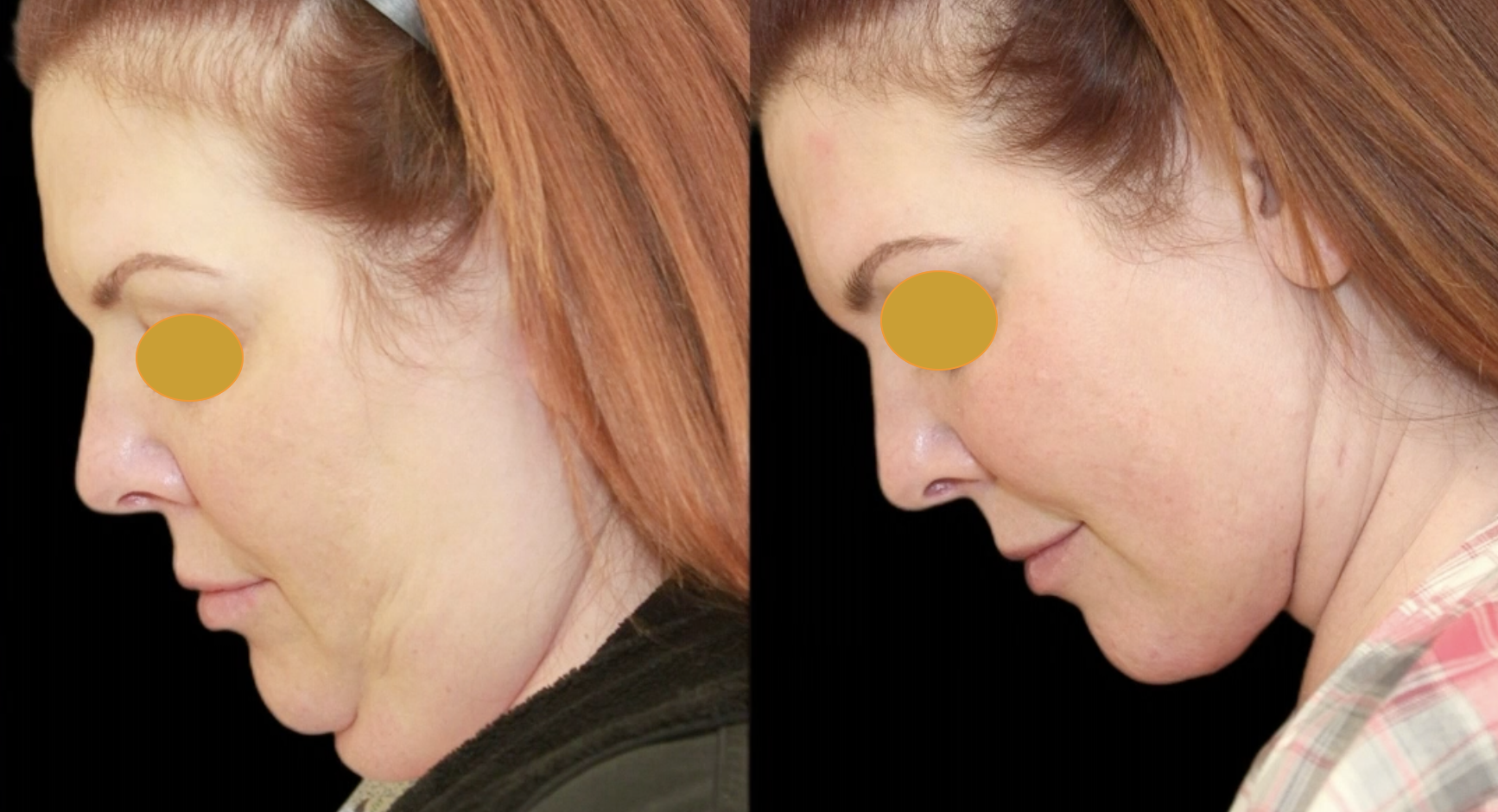 Before-and-after neck or face-and-neck lift comparison, Dr. Hakan Demir source gallery, view 3