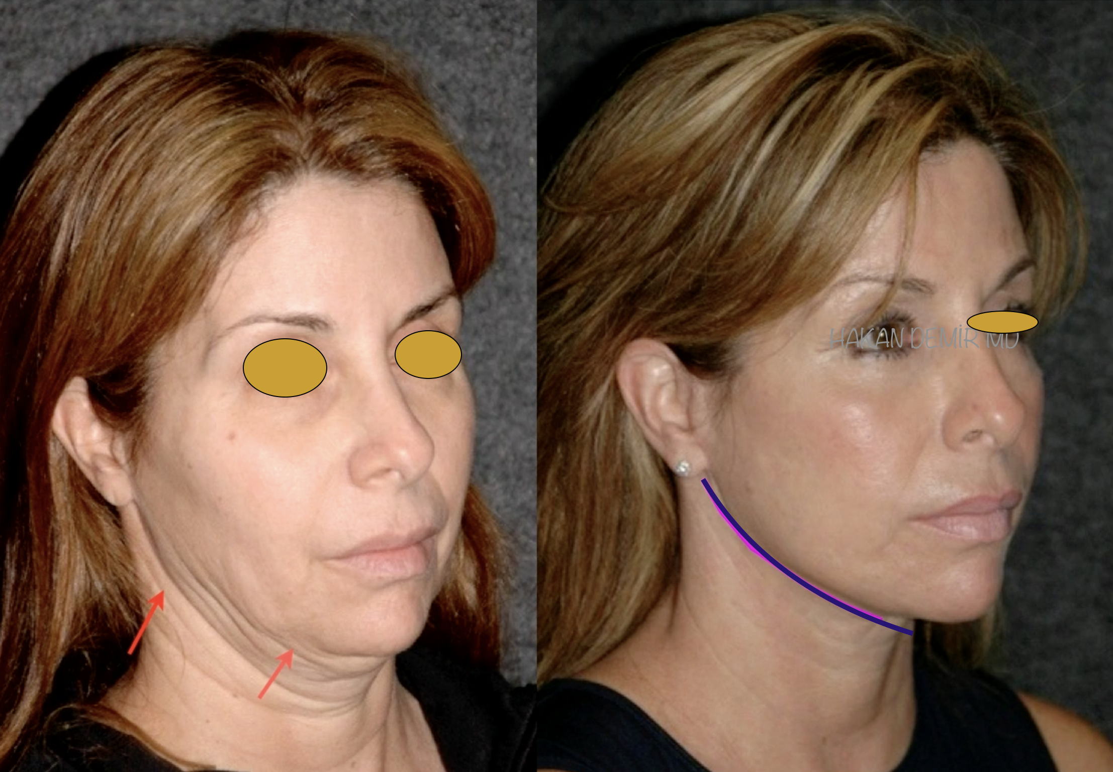 Before-and-after neck or face-and-neck lift comparison, Dr. Hakan Demir source gallery, view 4