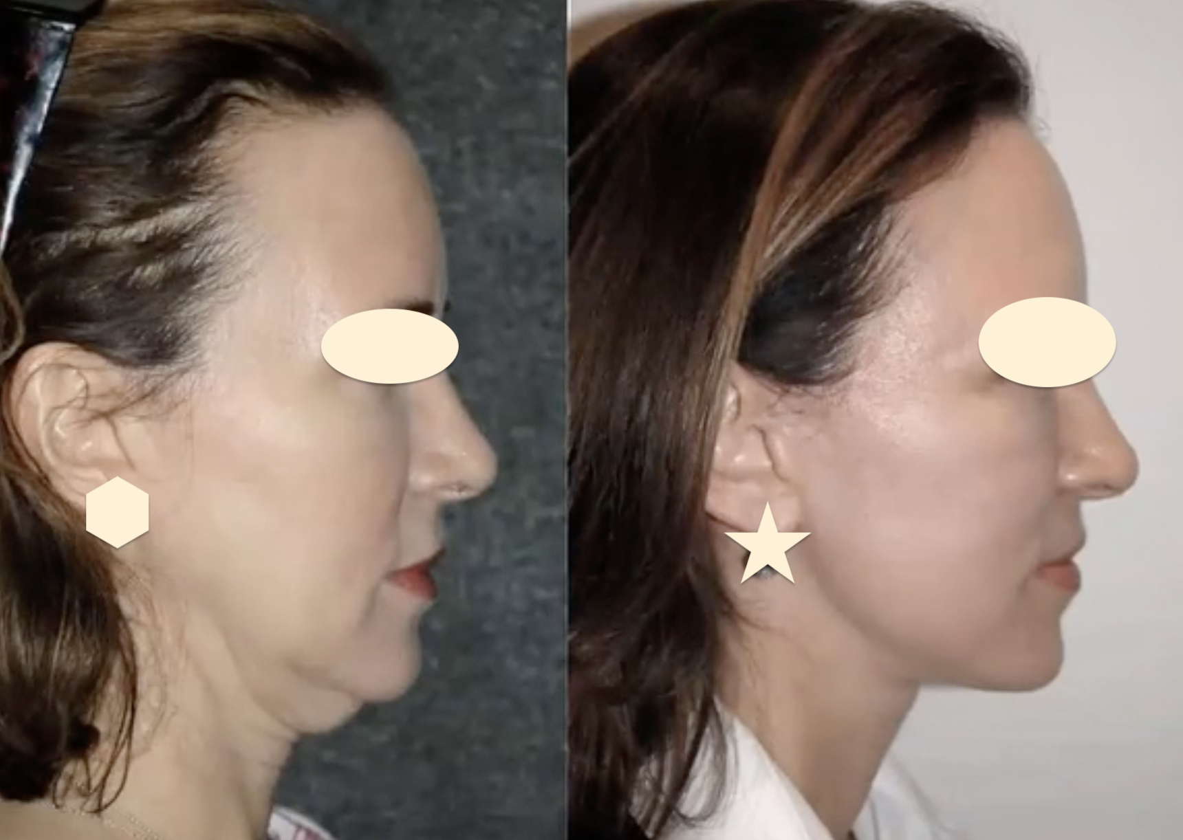 Before-and-after neck or face-and-neck lift comparison, Dr. Hakan Demir source gallery, view 5