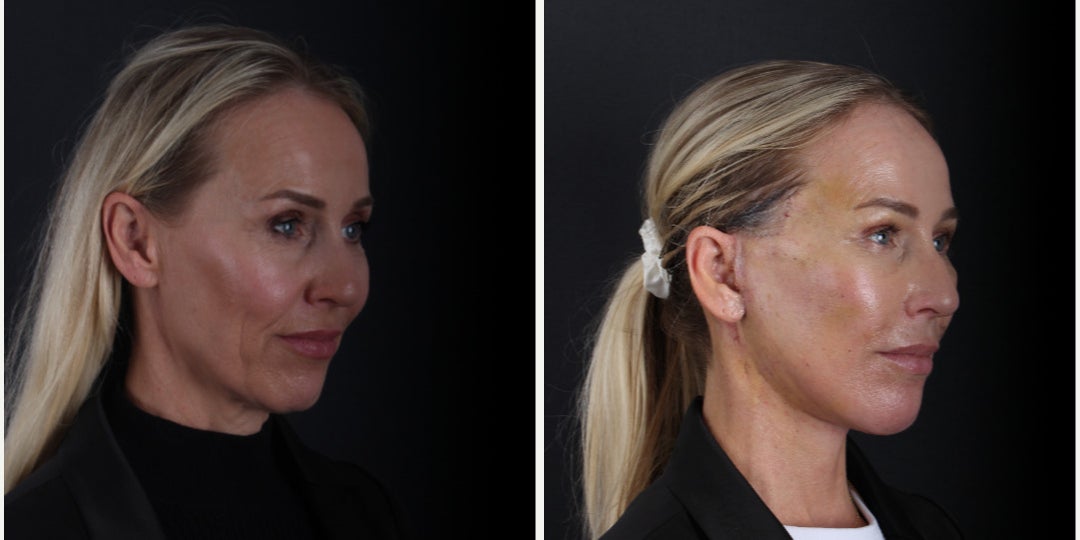 Before-and-after neck or face-and-neck lift comparison, Dr. Hasan Duygulu source gallery, view 1