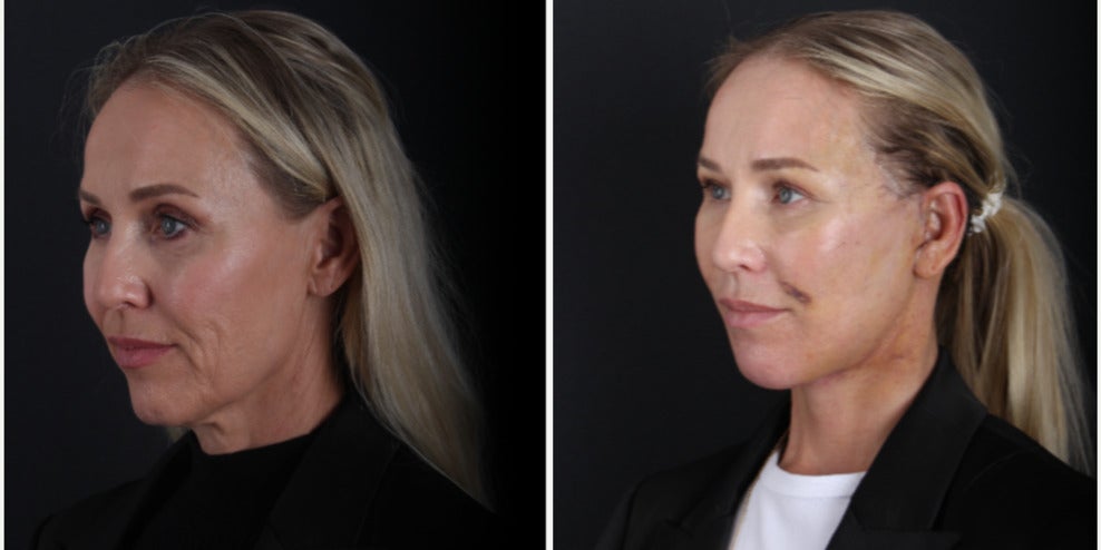 Before-and-after neck or face-and-neck lift comparison, Dr. Hasan Duygulu source gallery, view 2
