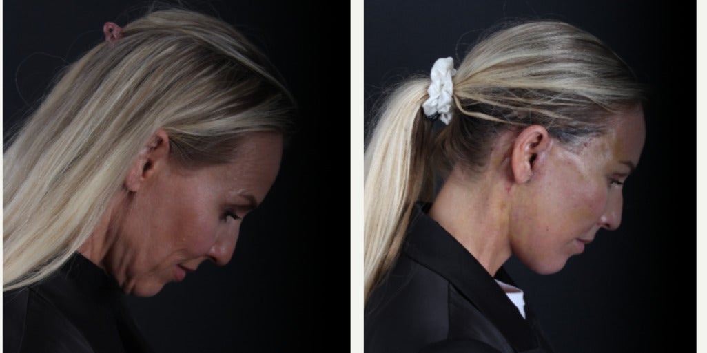 Before-and-after neck or face-and-neck lift comparison, Dr. Hasan Duygulu source gallery, view 3