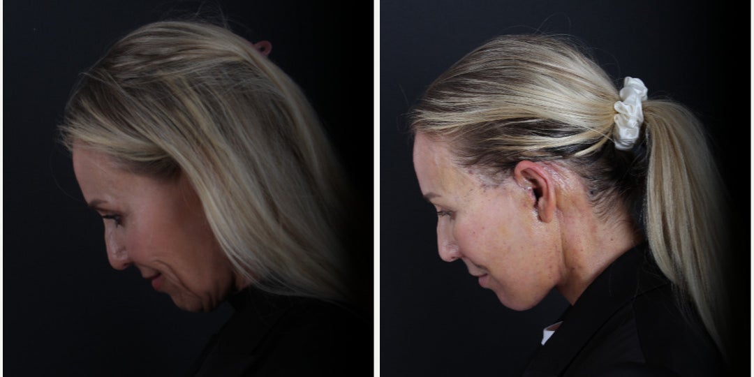 Before-and-after neck or face-and-neck lift comparison, Dr. Hasan Duygulu source gallery, view 4