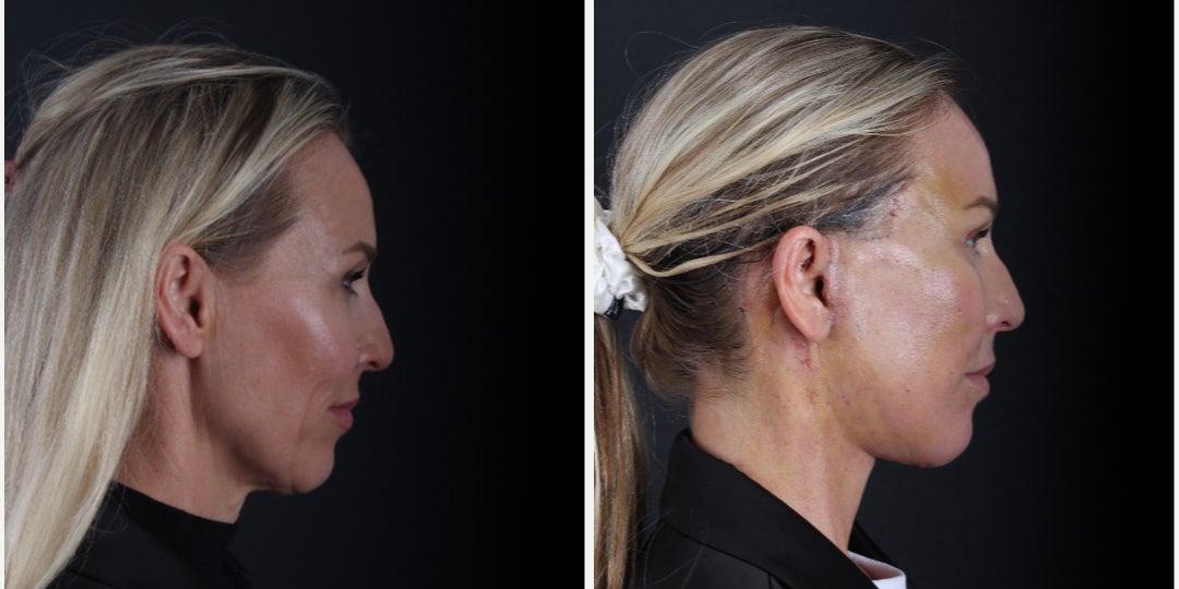 Before-and-after neck or face-and-neck lift comparison, Dr. Hasan Duygulu source gallery, view 5
