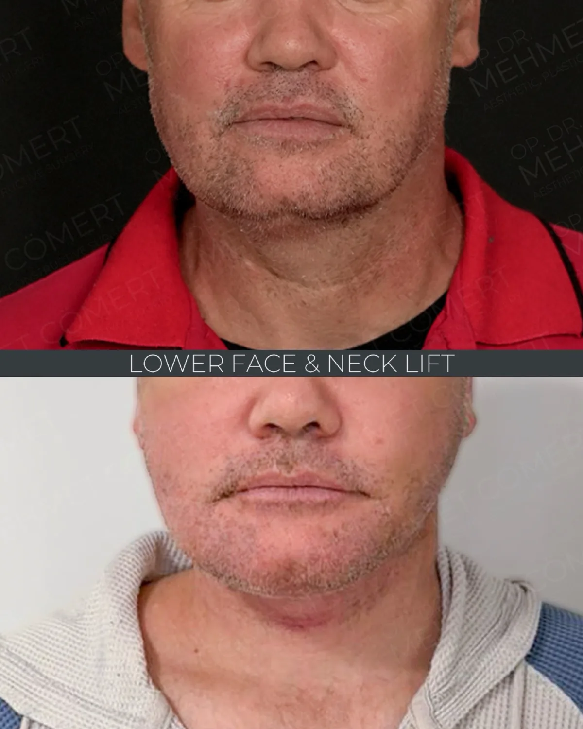 Before-and-after neck or face-and-neck lift comparison, Dr. Mehmet Comert source gallery, view 1