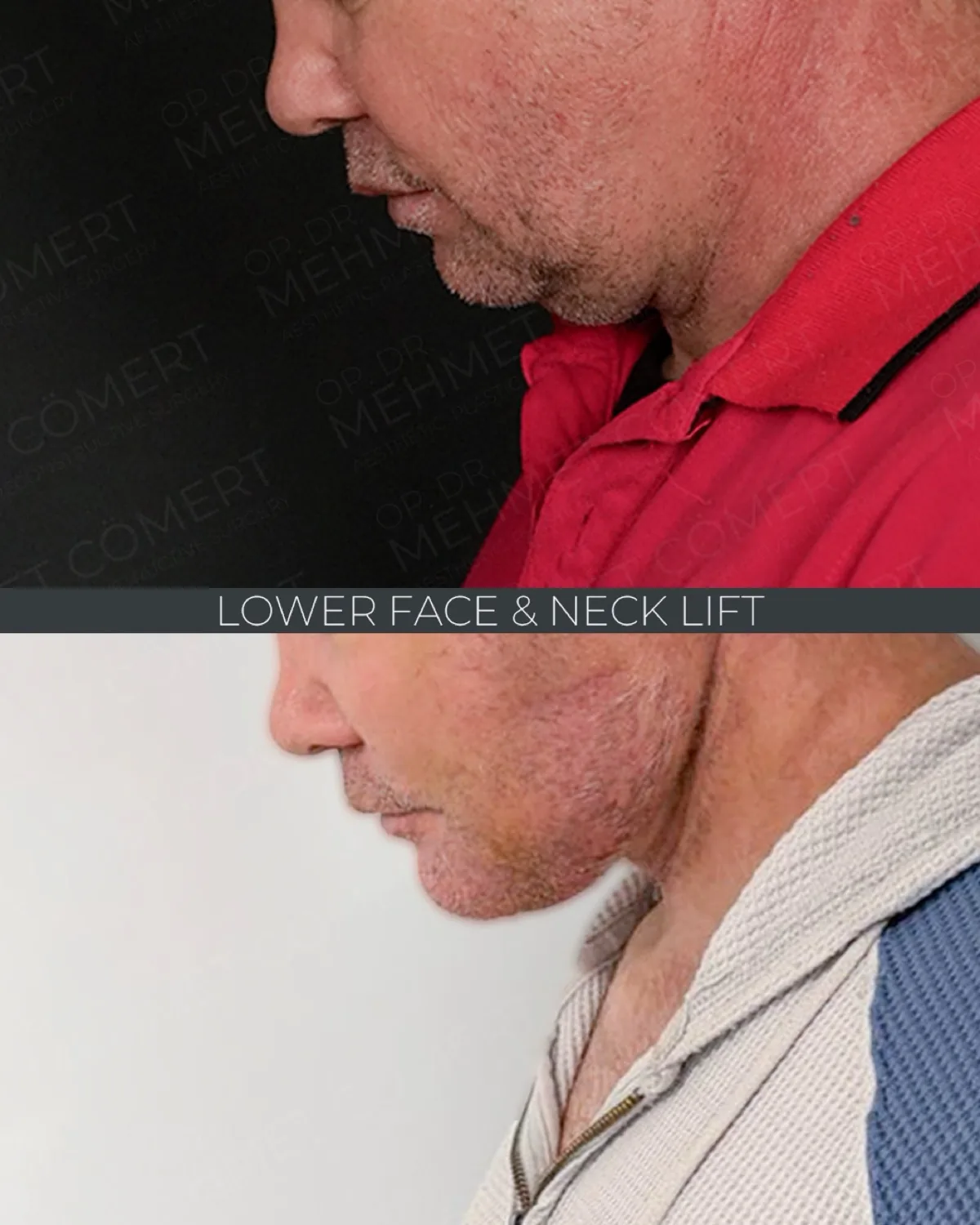 Before-and-after neck or face-and-neck lift comparison, Dr. Mehmet Comert source gallery, view 2
