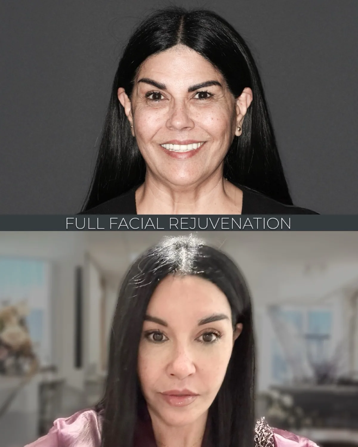Before-and-after neck or face-and-neck lift comparison, Dr. Mehmet Comert source gallery, view 3