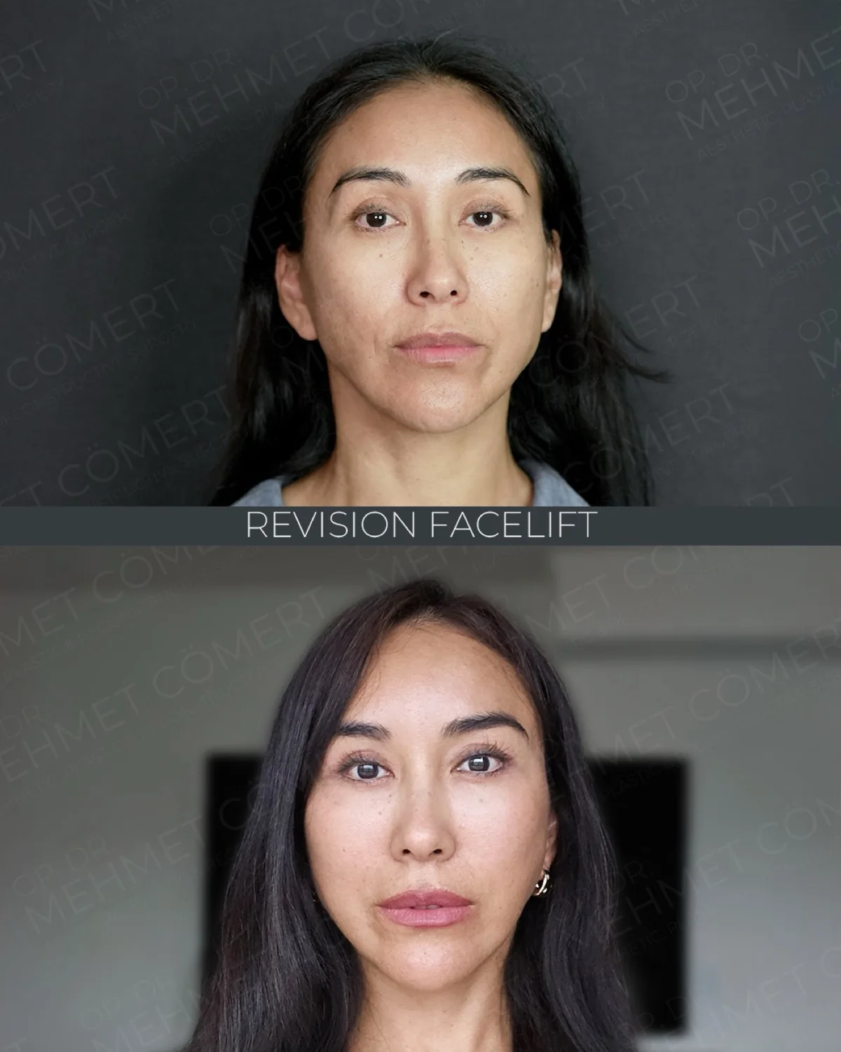 Before-and-after neck or face-and-neck lift comparison, Dr. Mehmet Comert source gallery, view 4