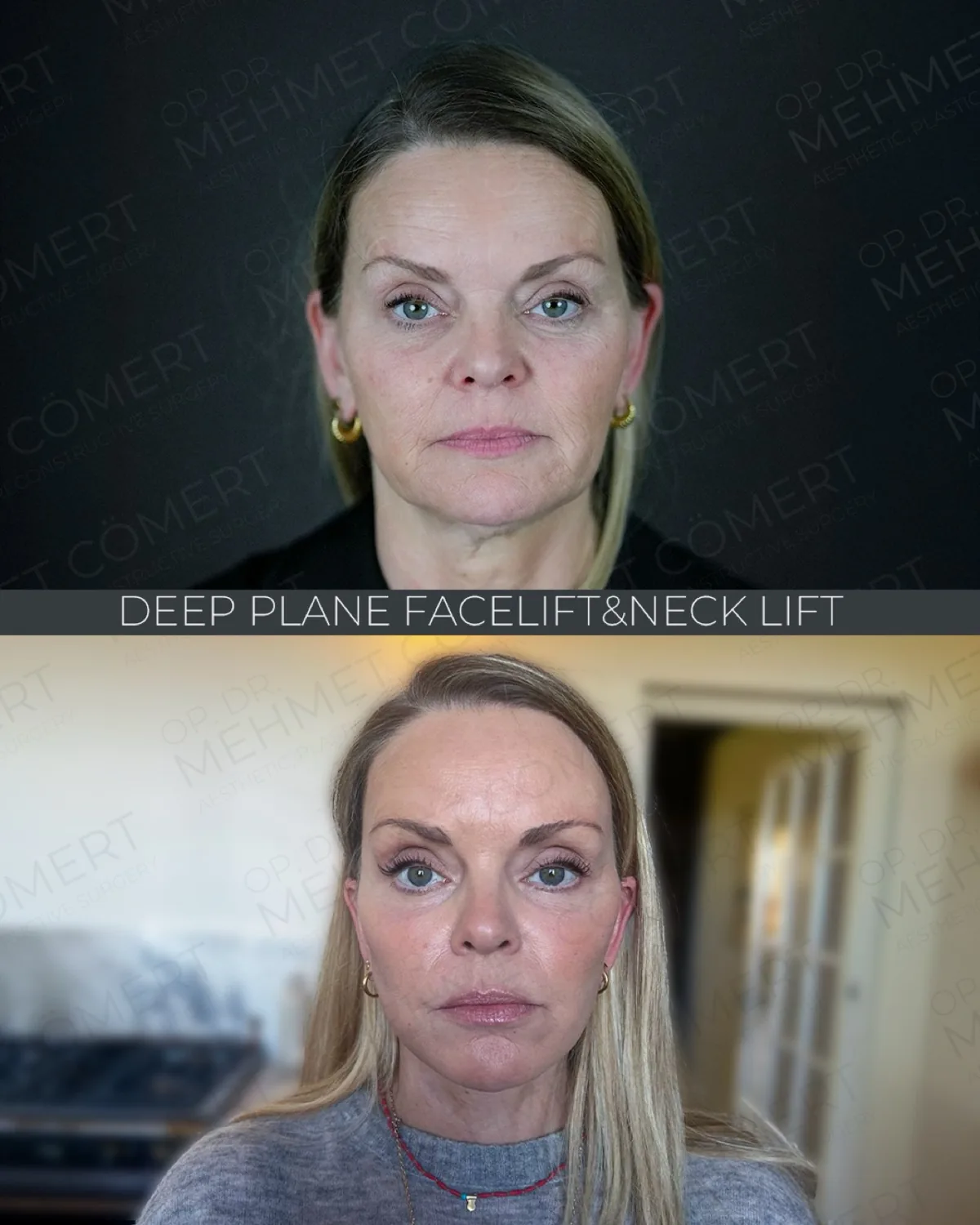 Before-and-after neck or face-and-neck lift comparison, Dr. Mehmet Comert source gallery, view 5