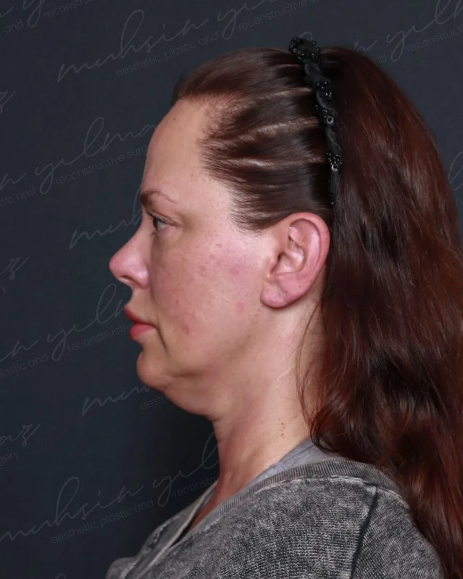 Dr. Mahmut Muhsin Yilmaz neck-lift source-gallery case 2, before view