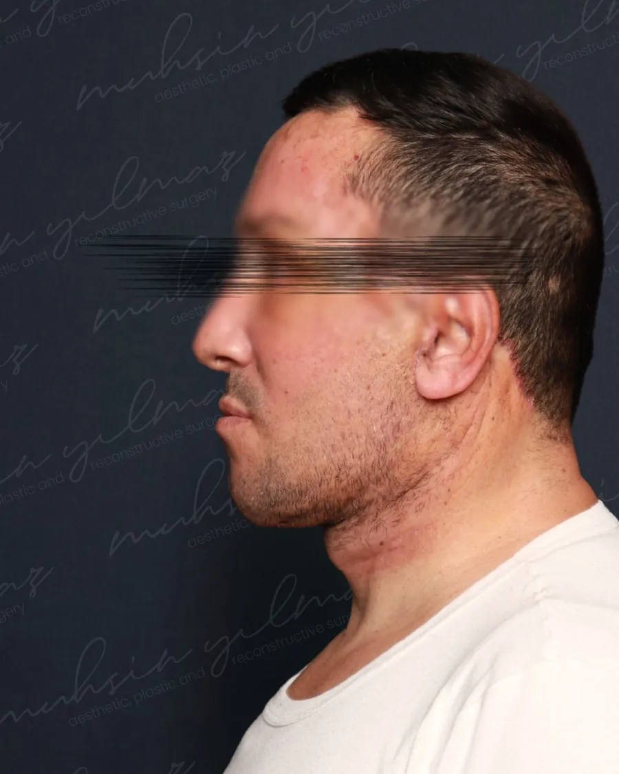 Dr. Mahmut Muhsin Yilmaz neck-lift source-gallery case 3, after view