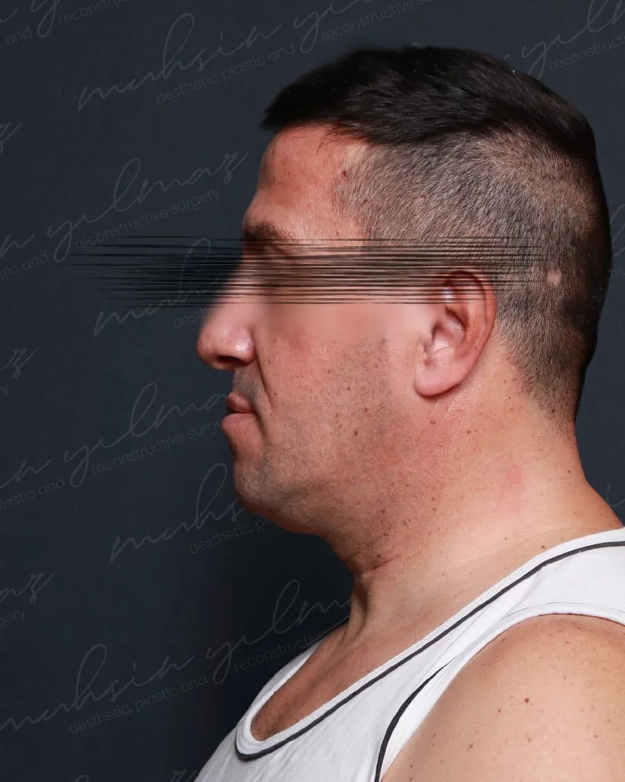 Dr. Mahmut Muhsin Yilmaz neck-lift source-gallery case 3, before view