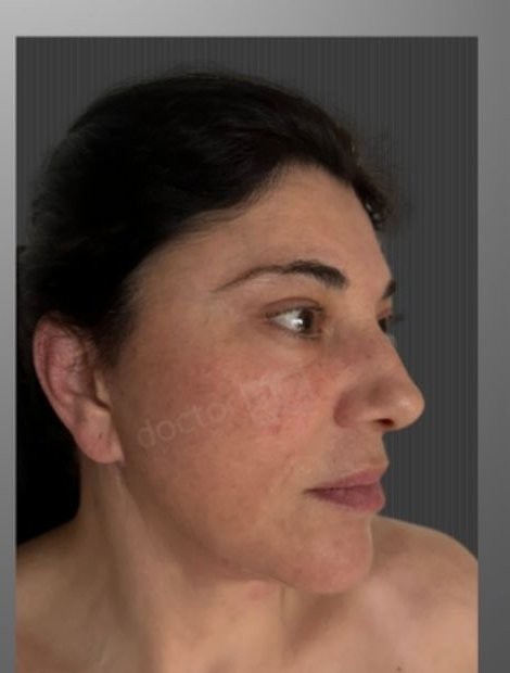 Dr. Umut Zereyak neck-lift source-gallery case 2, after view
