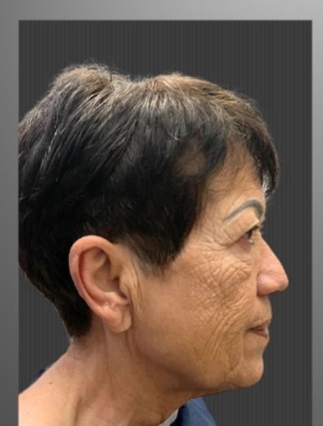 Dr. Umut Zereyak neck-lift source-gallery case 4, before view