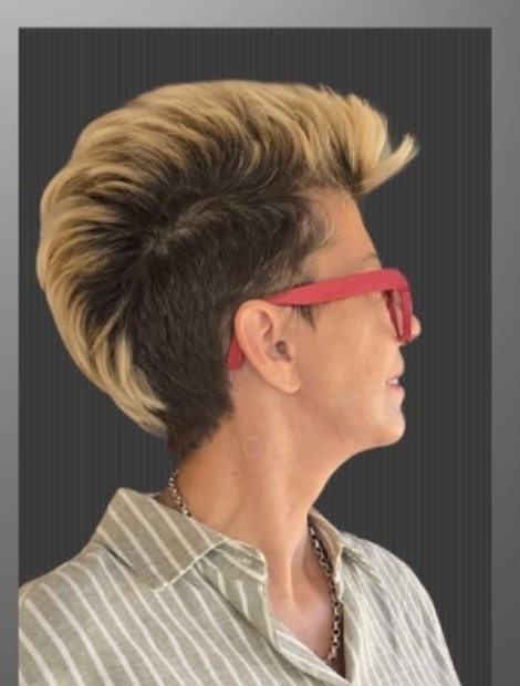 Dr. Umut Zereyak neck-lift source-gallery case 5, after view