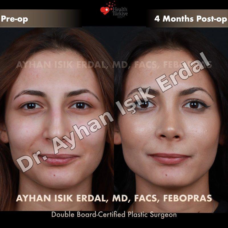 Provider-published before-and-after comparison, Ayhan Işık Erdal, image 1