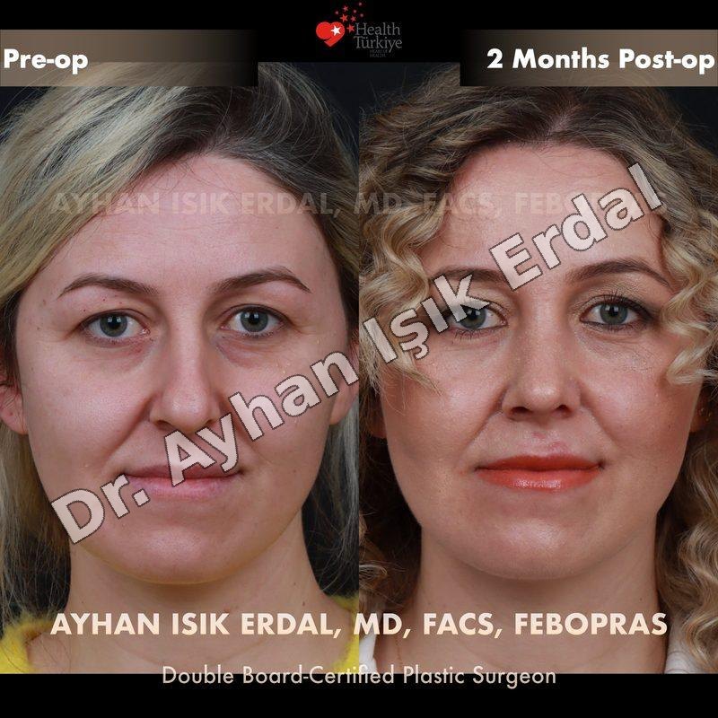 Provider-published before-and-after comparison, Ayhan Işık Erdal, image 2