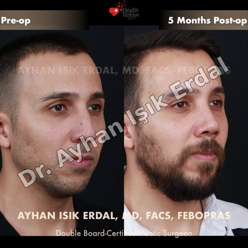 Provider-published before-and-after comparison, Ayhan Işık Erdal, image 3