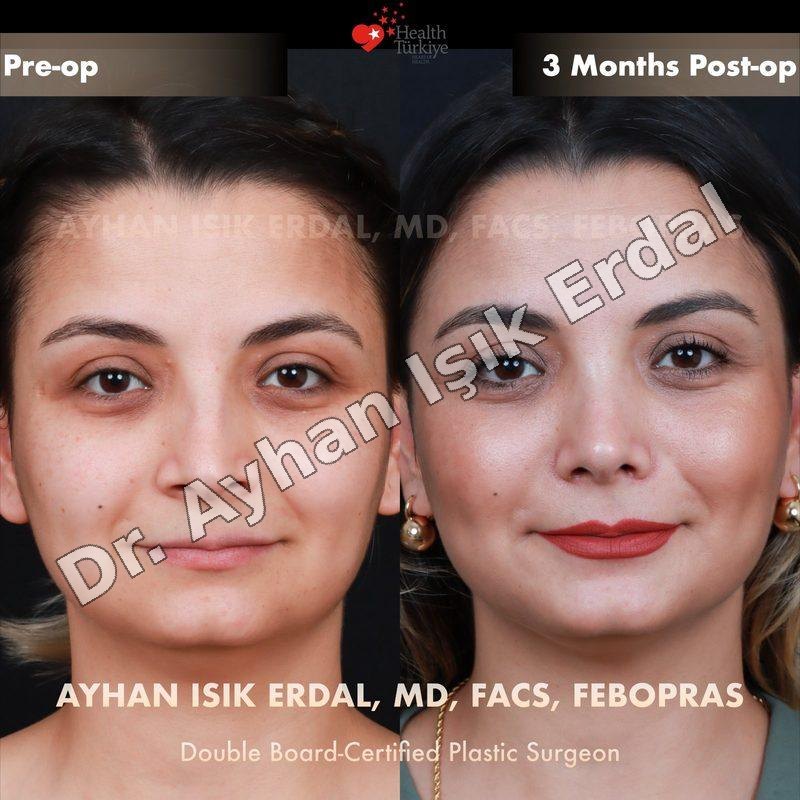 Provider-published before-and-after comparison, Ayhan Işık Erdal, image 4