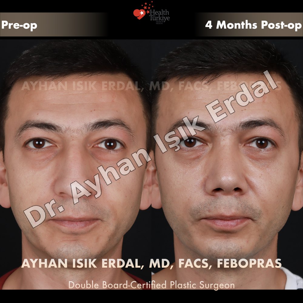 Provider-published before-and-after comparison, Ayhan Işık Erdal, image 5